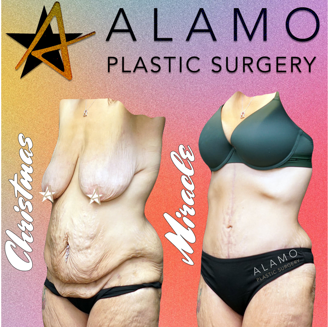 Breast Lift San Antonio  Voted #1 Best Plastic Surgeon